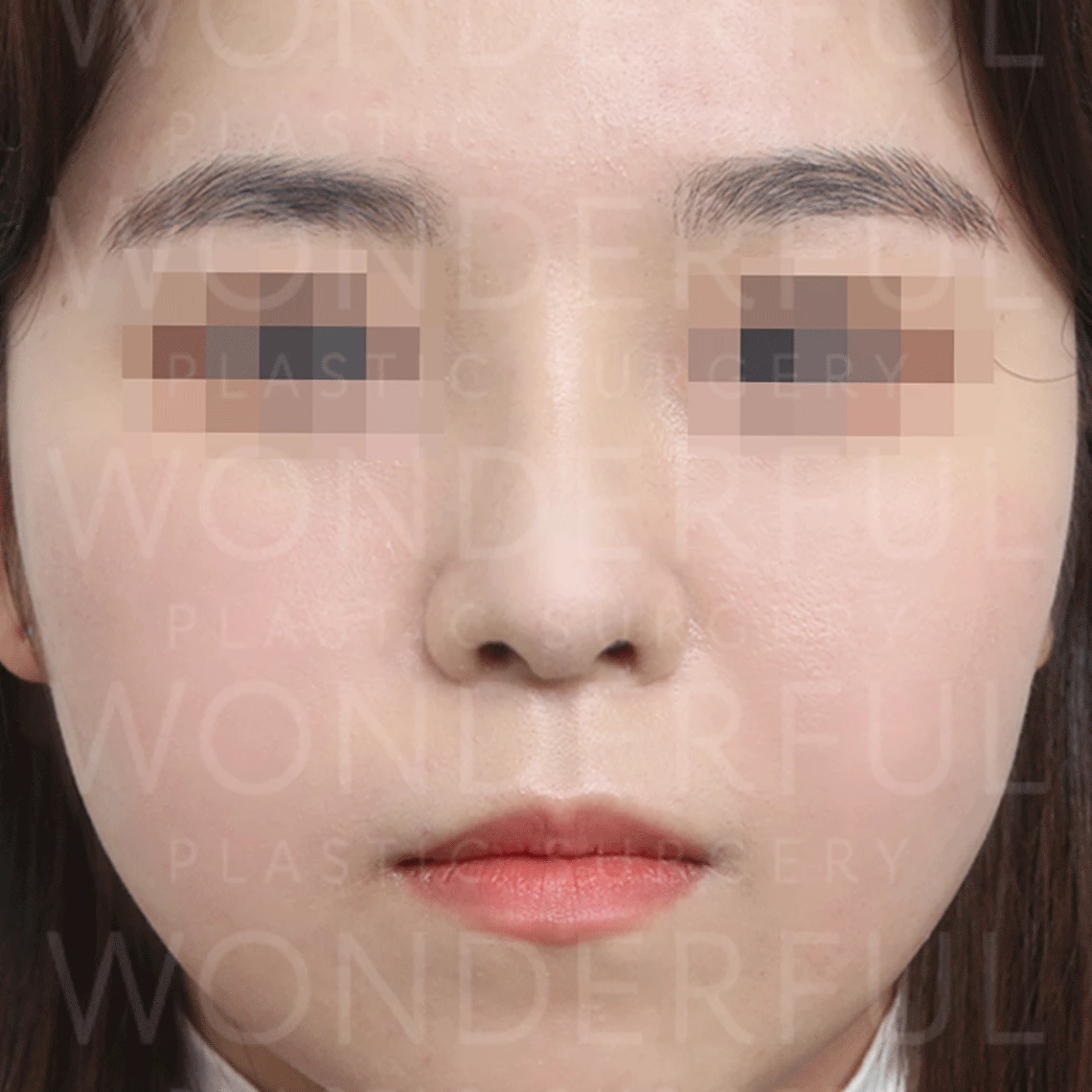 wonderful-plastic-surgery-hospital-korea-nose-rhinoplasty-before-after-results-after-1